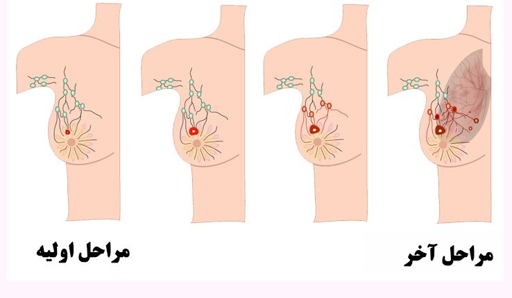 علائم هشدار دهنده اولیه و علائم تهاجمی سرطان سینه چیست ؟