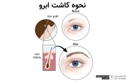 بهترین بانک مو برای کاشت ابرو