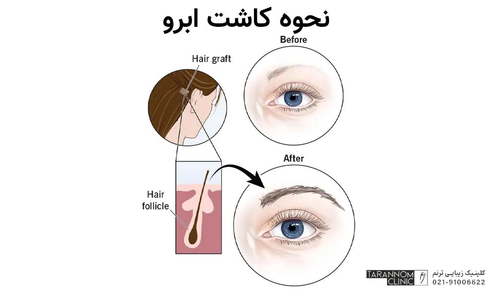 بهترین بانک مو برای کاشت ابرو