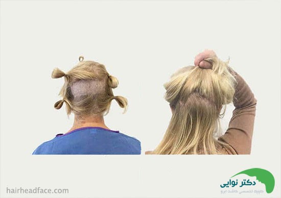 بهترین بانک مو برای کاشت ابرو