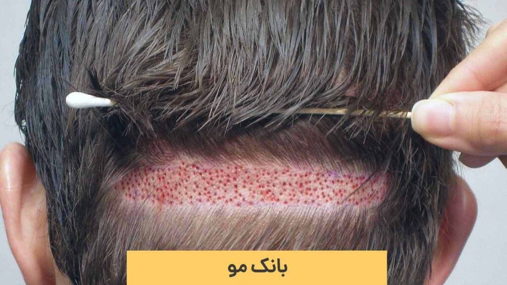بهترین بانک مو برای کاشت ابرو