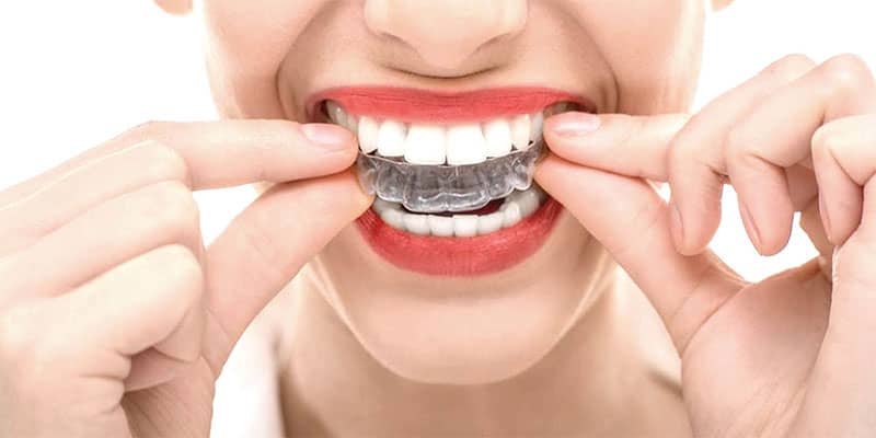 قیمت ارتودنسی نامرئی